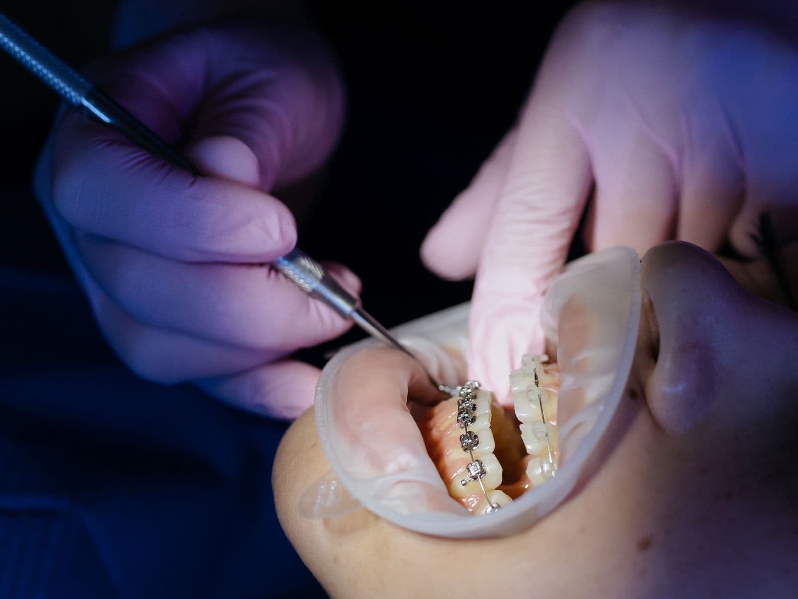 Control odontológico de brackets durante un tratamiento de ortodoncia