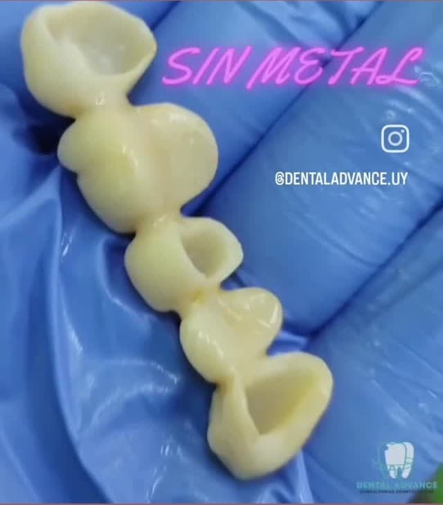 Caso clínico de puente fijo de zirconio realizado por Advance Dental & Facial
